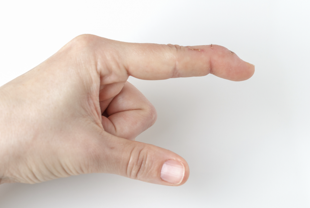 sõrme vigastus, sõrme luumurd, sõrme murd, mallet finger, vasarasõrm, sõrme haav, murd, luumurd, traumapunkt